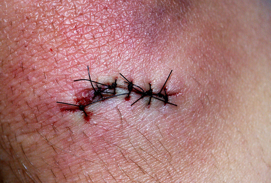 Knee Laceration,Closed With Sutures