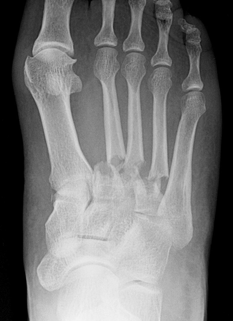 Foot Fractures