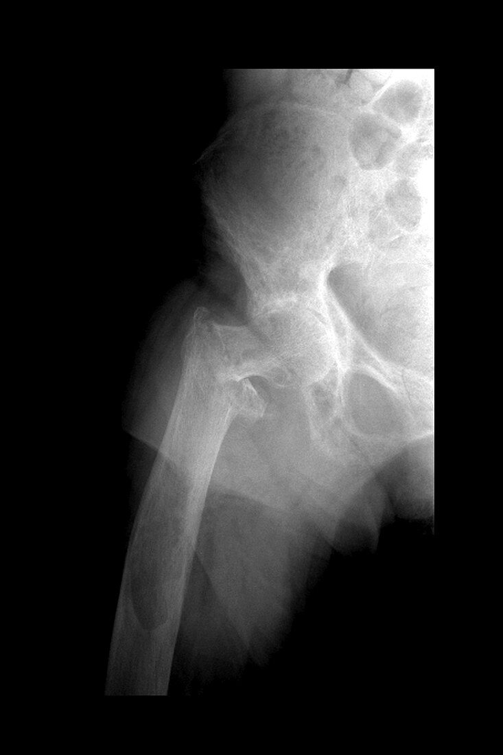 X-ray of leg fracture