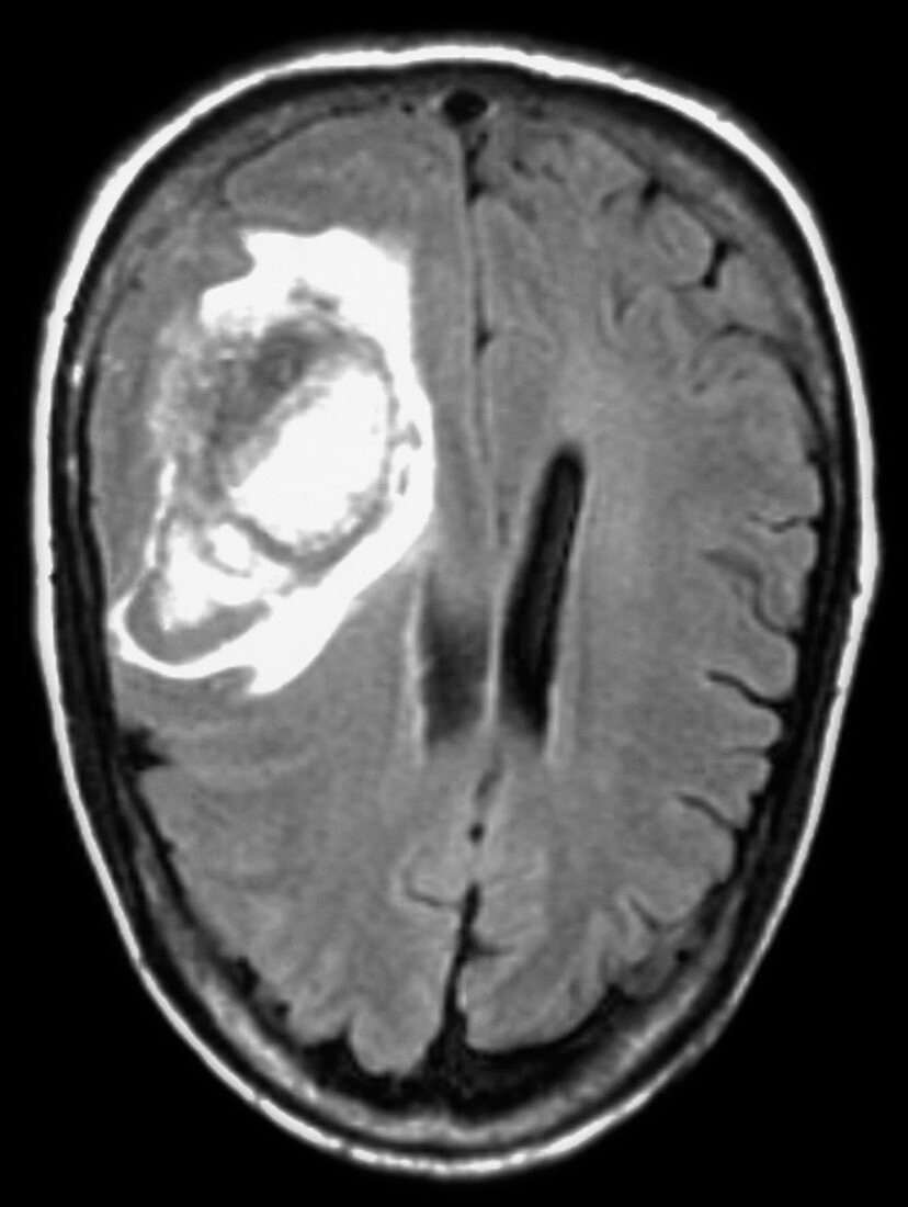 MRI of Head Injury