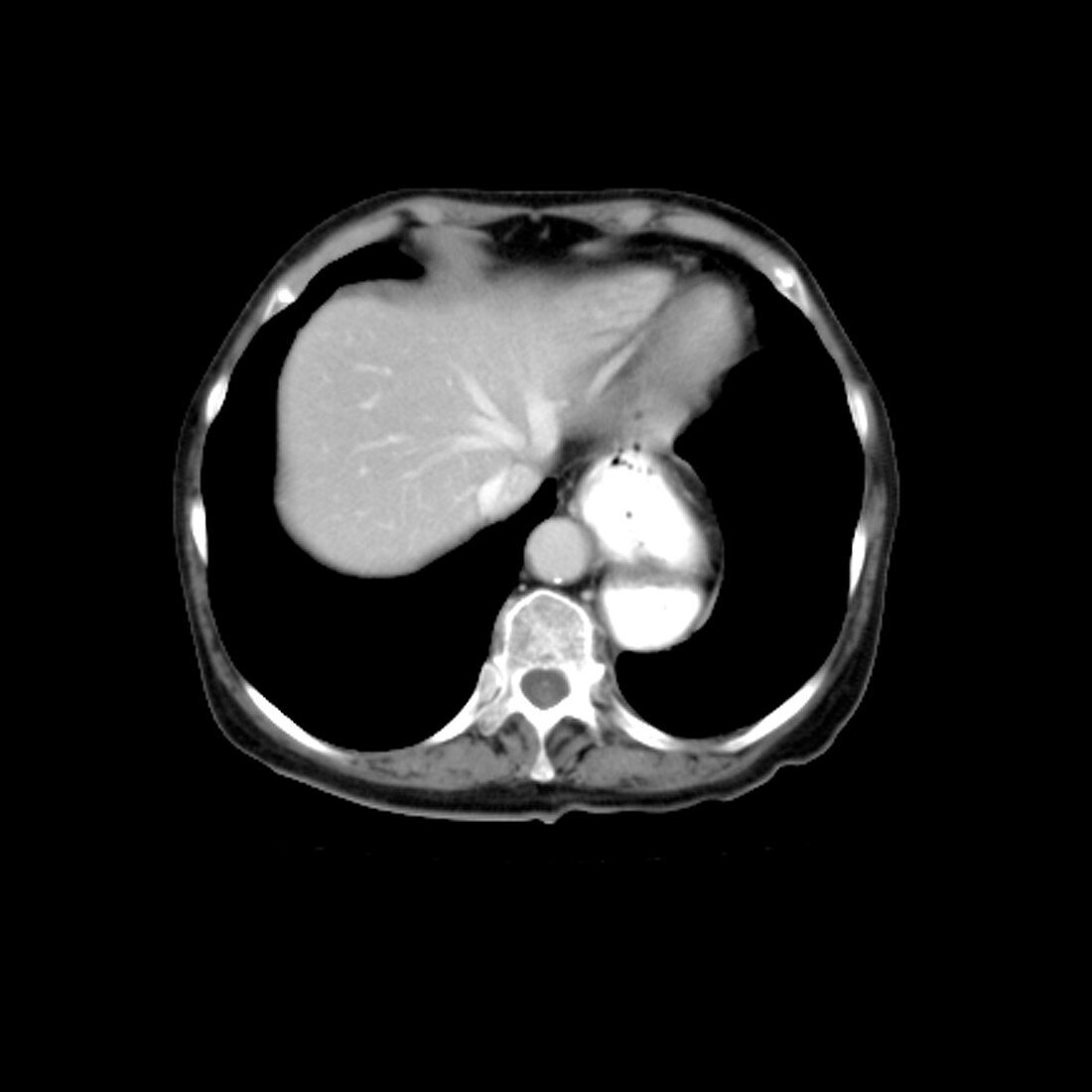 Hiatal Hernia