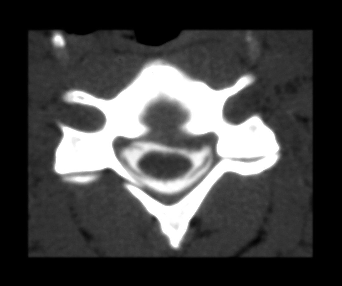 CT of Herniated Intervertebral Disc