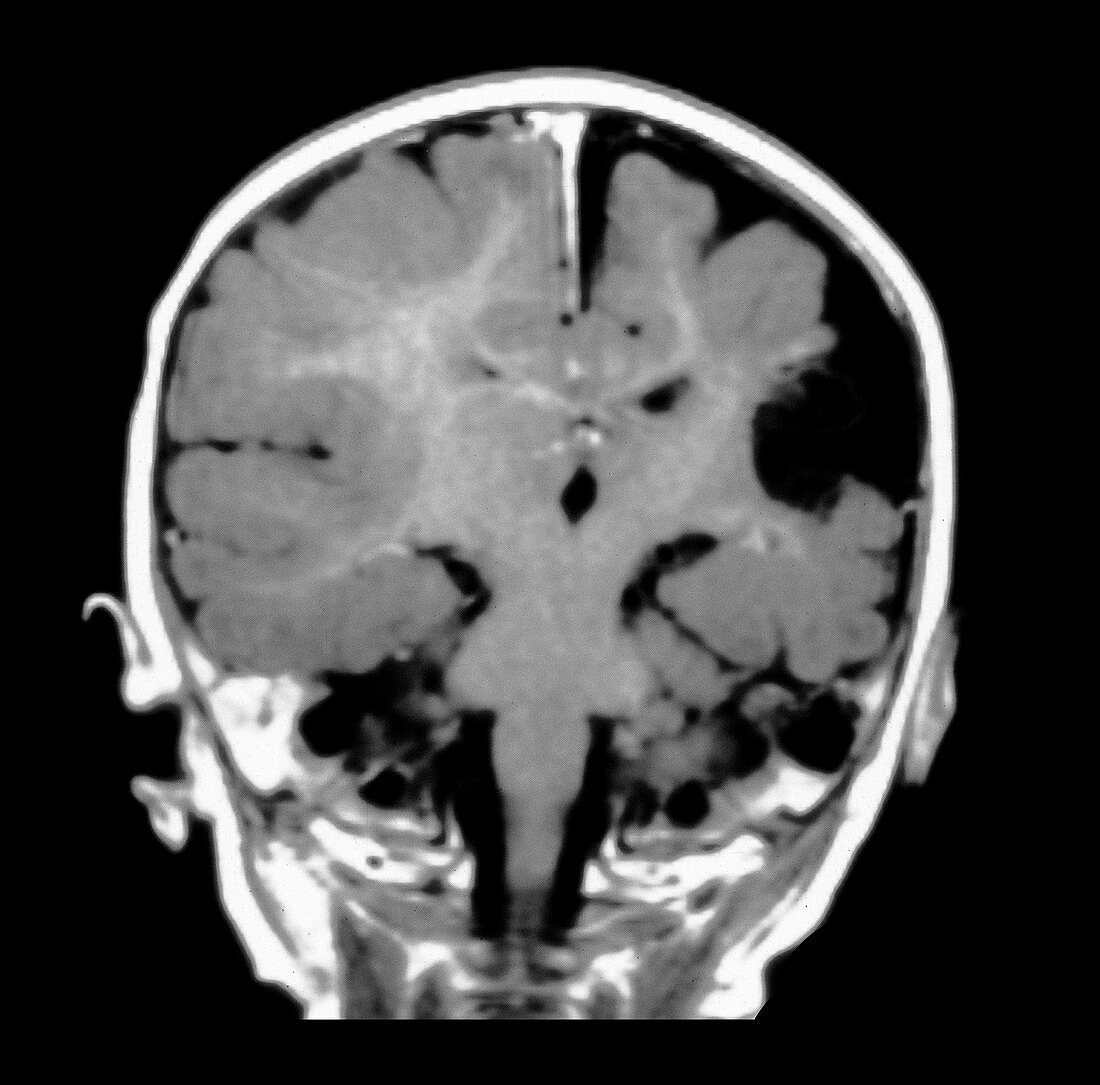 MRI of In-utero Brain Injury
