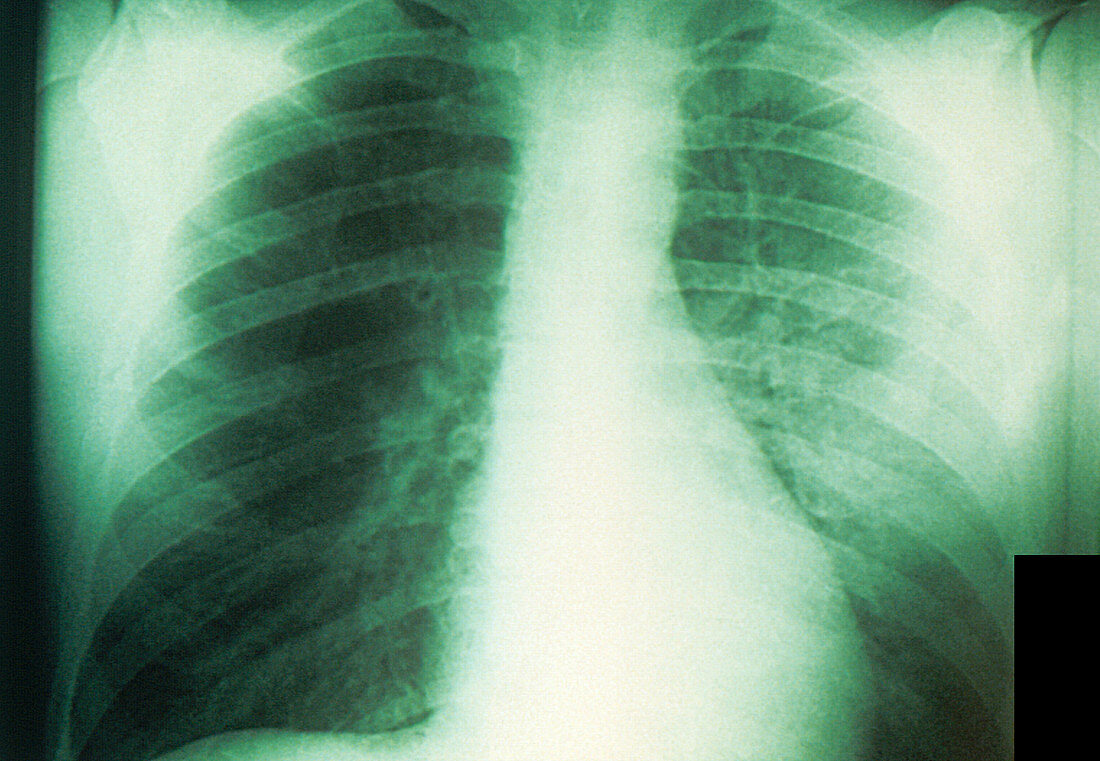 Plague X-Ray