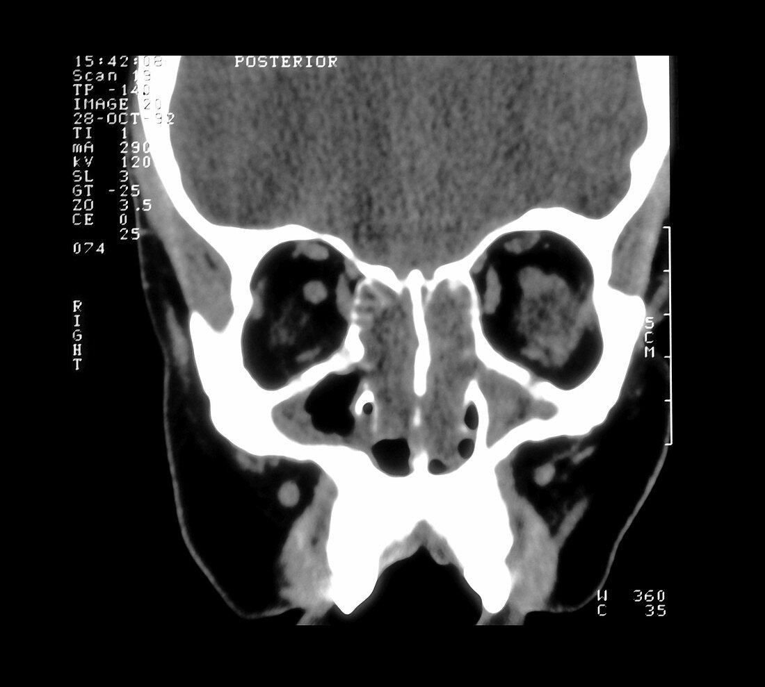 CT of Sinuses