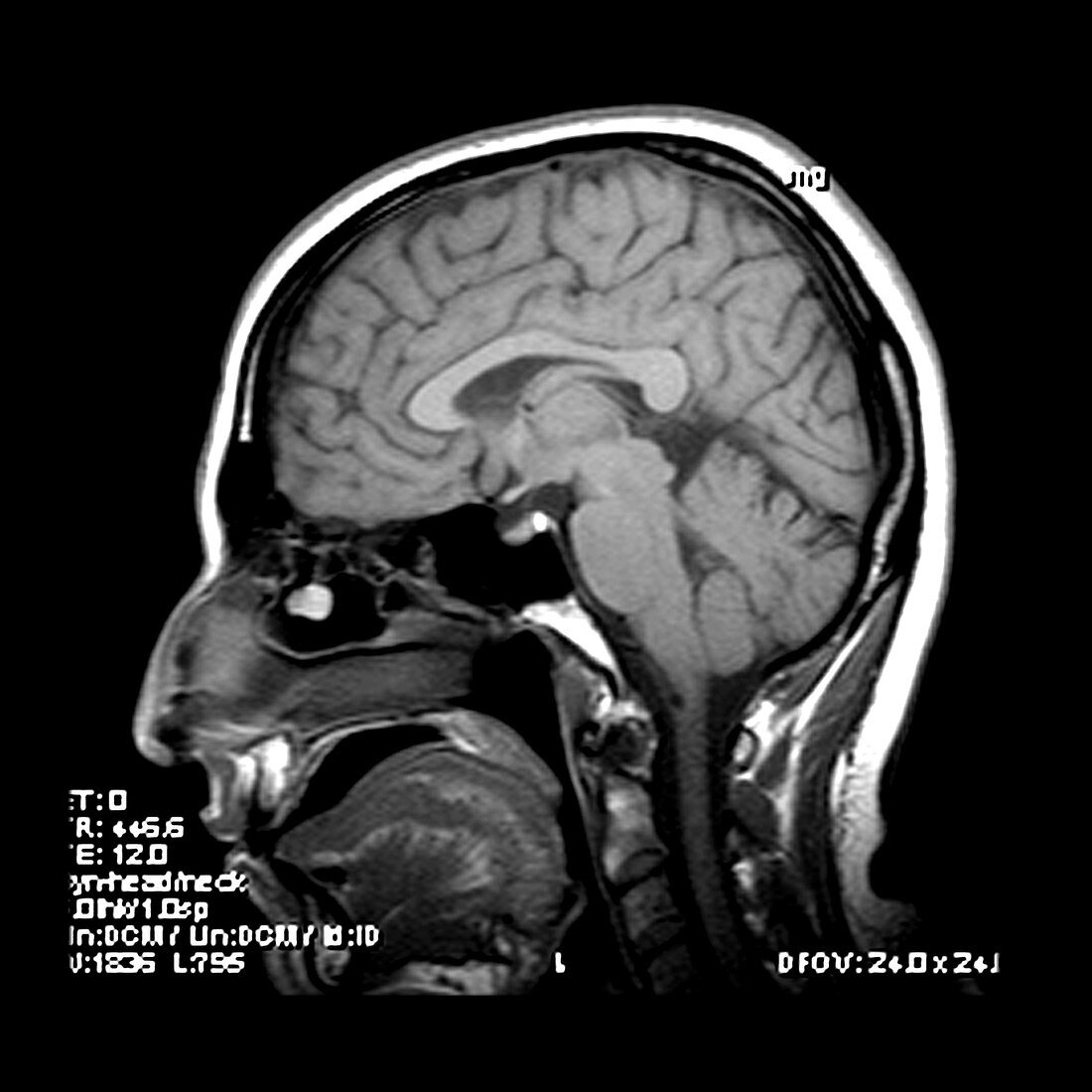 MRI of Nasal Polyp and Pneumitization