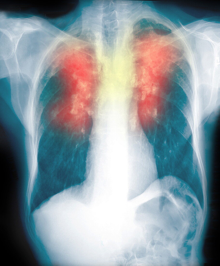 Lung silicosis,X-ray