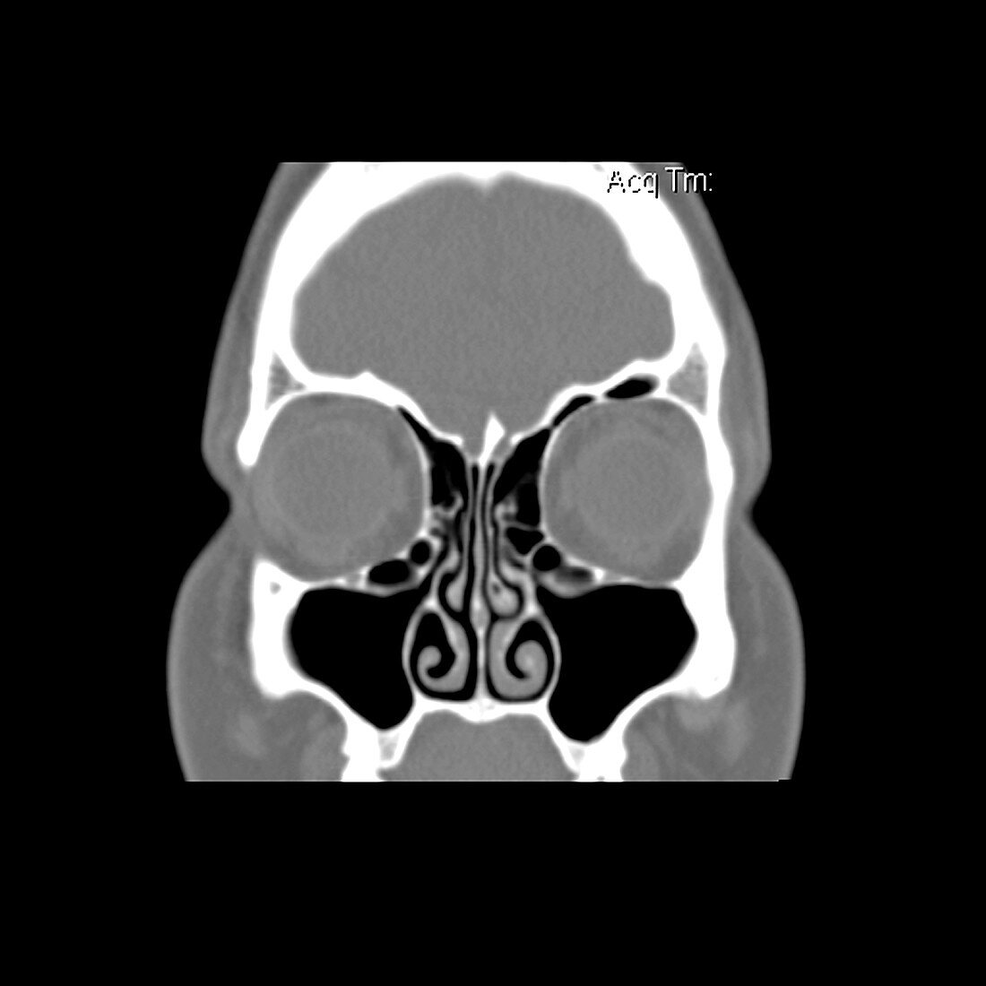 CT of Haller Air Cells on Sinus CT