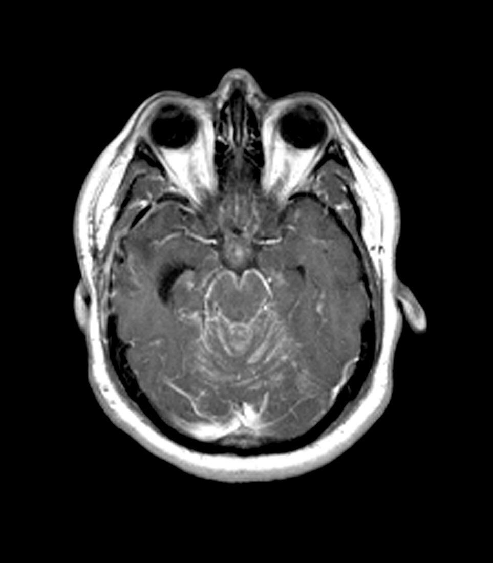 MRI of Neurosarcoidosis