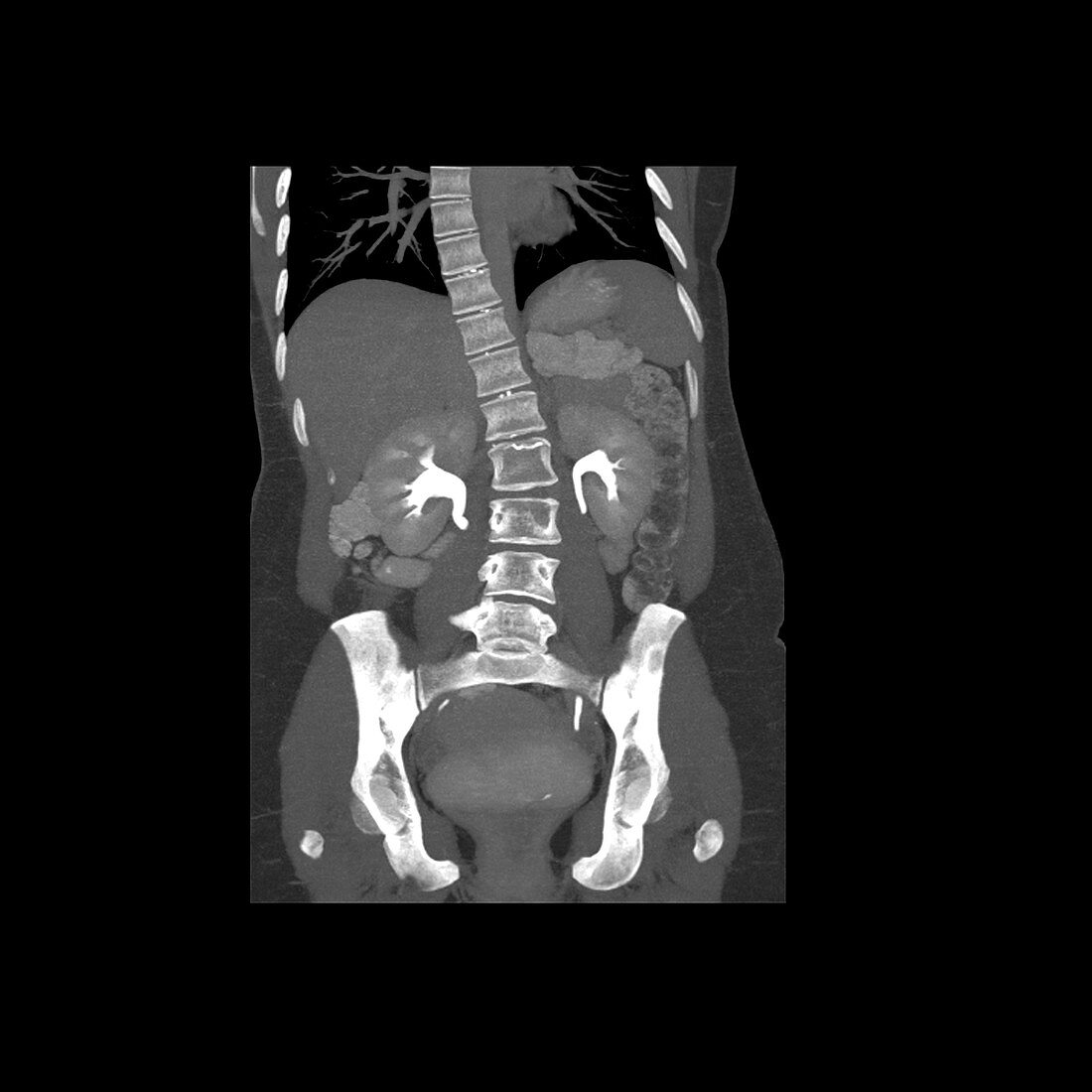 Thoracolumbar Scoliosis