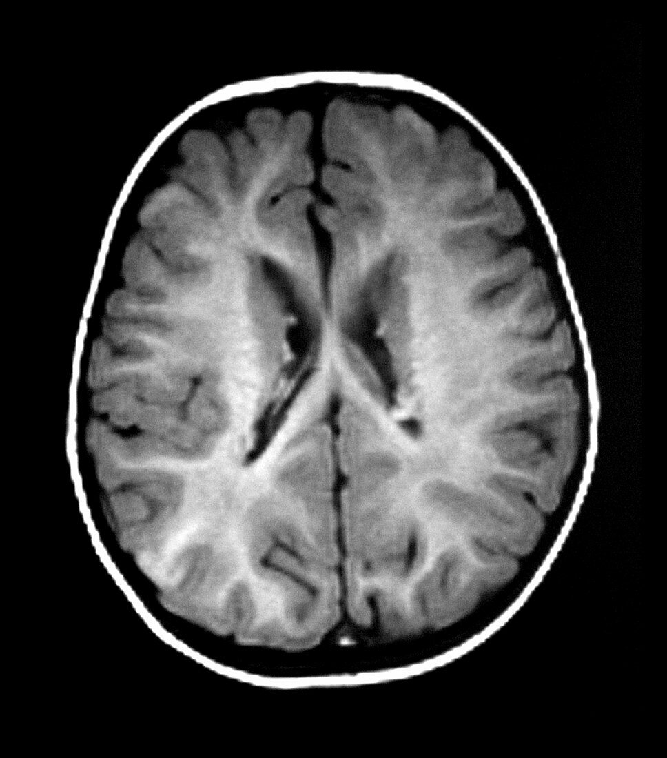 MRI of Tuberous Sclerosis