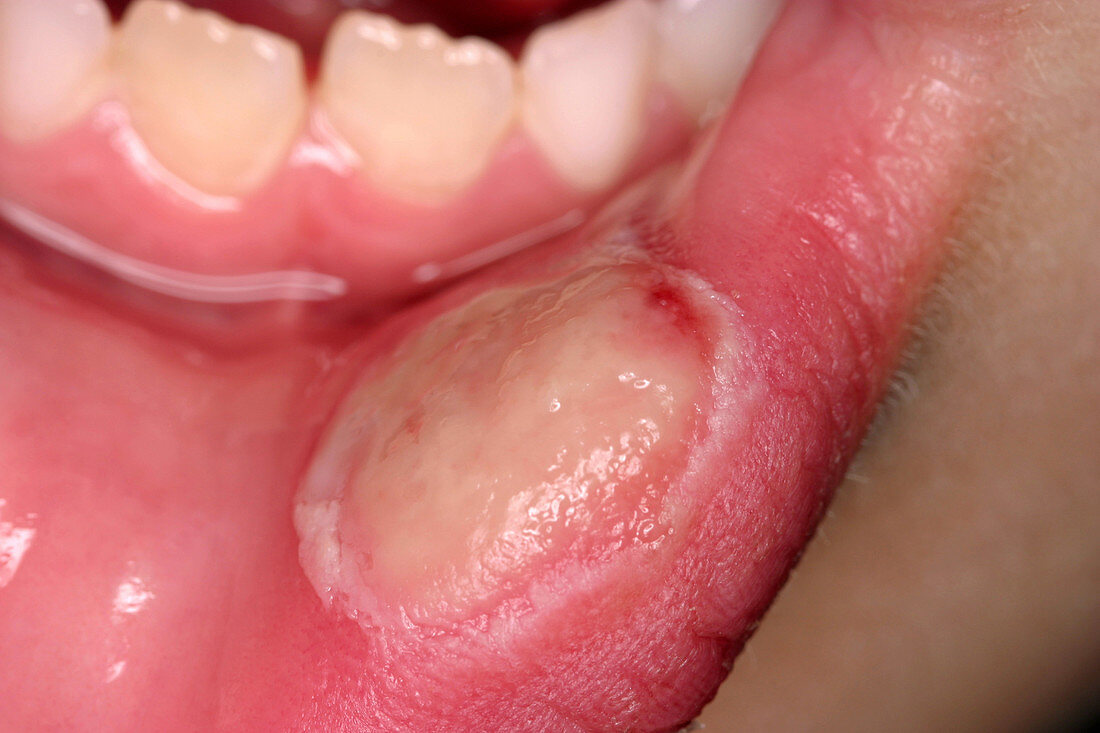 Canker Sore (Aphthous stomatitis)