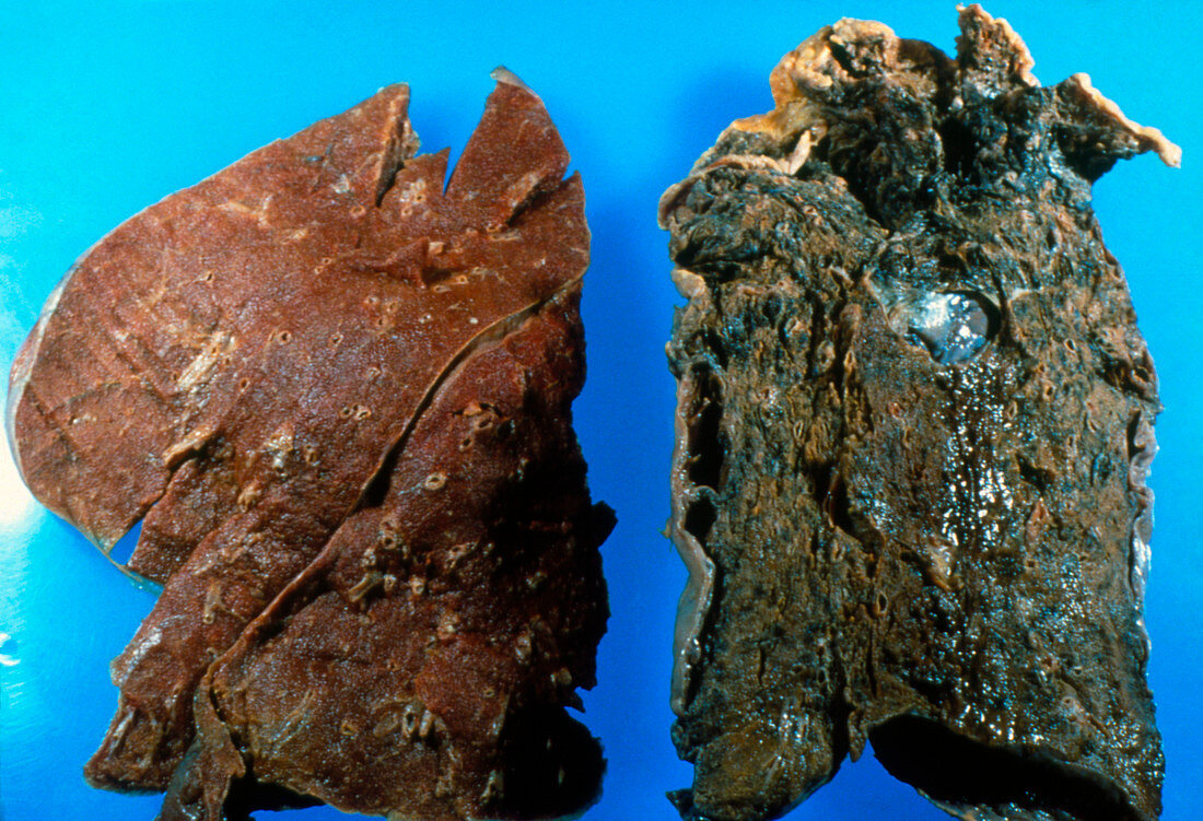 Gross specimen of normal & smoker's lungs