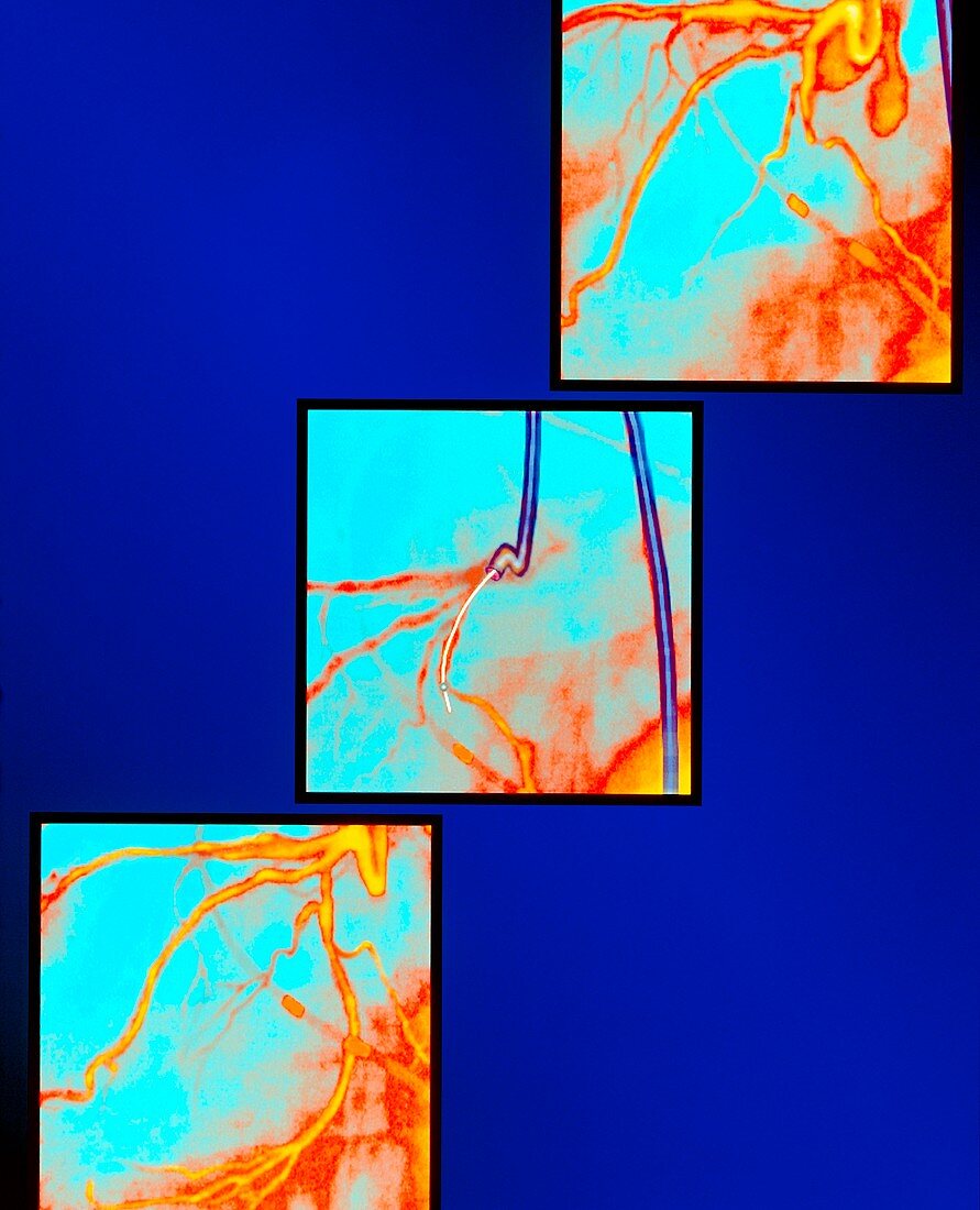 Three stage view of coronary angioplasty