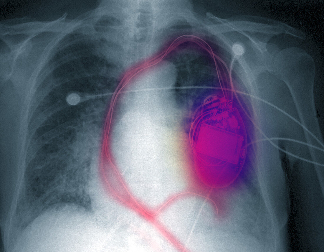 X-ray of man with pacemaker defibrillator