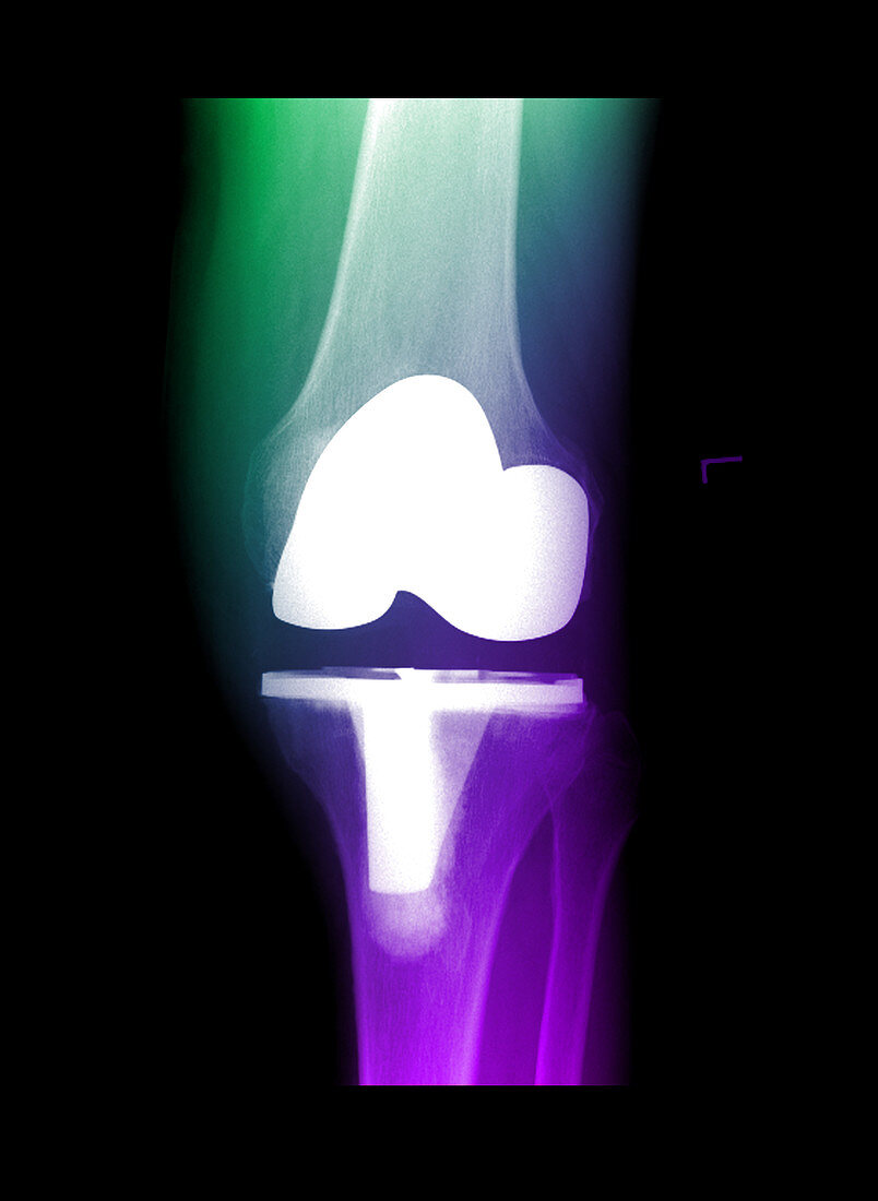 X-ray of knee replacement