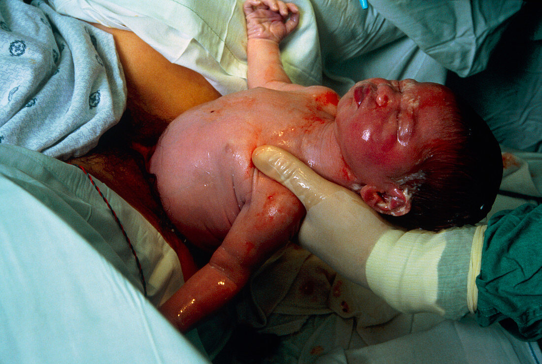 Childbirth: baby being born in hospital