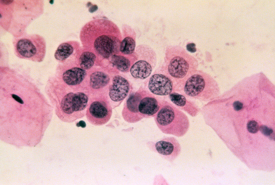 Uterine adenocarcinoma cells