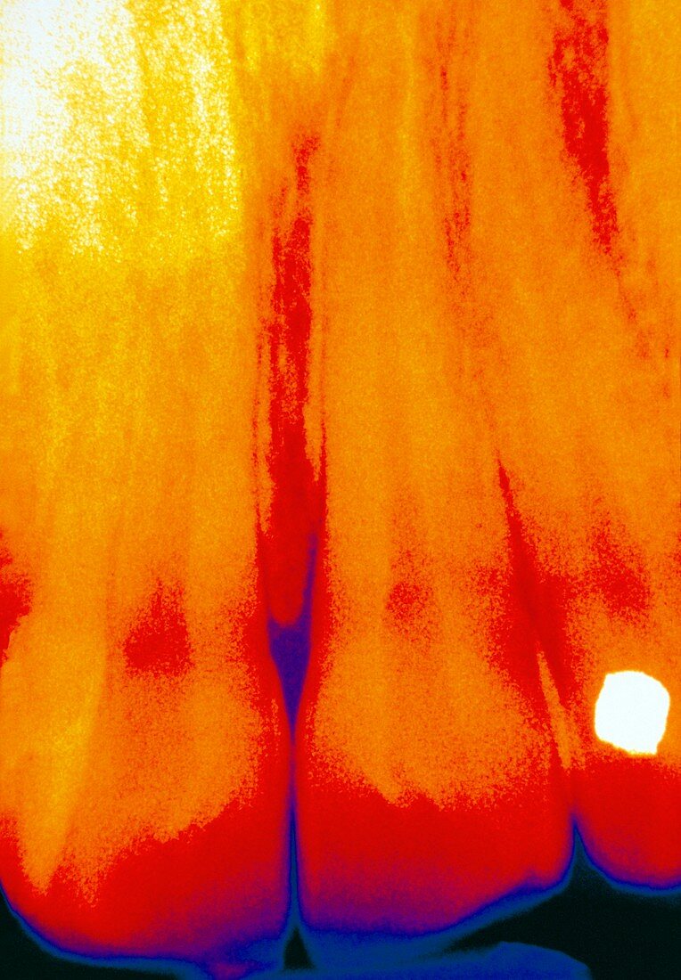 Coloured X-ray showing filling in a tooth
