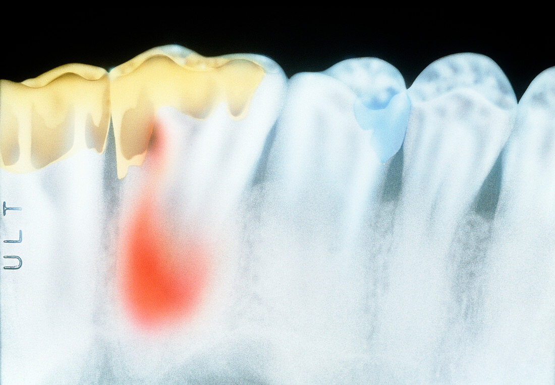 X-ray of molar teeth with gold fillings and cavity