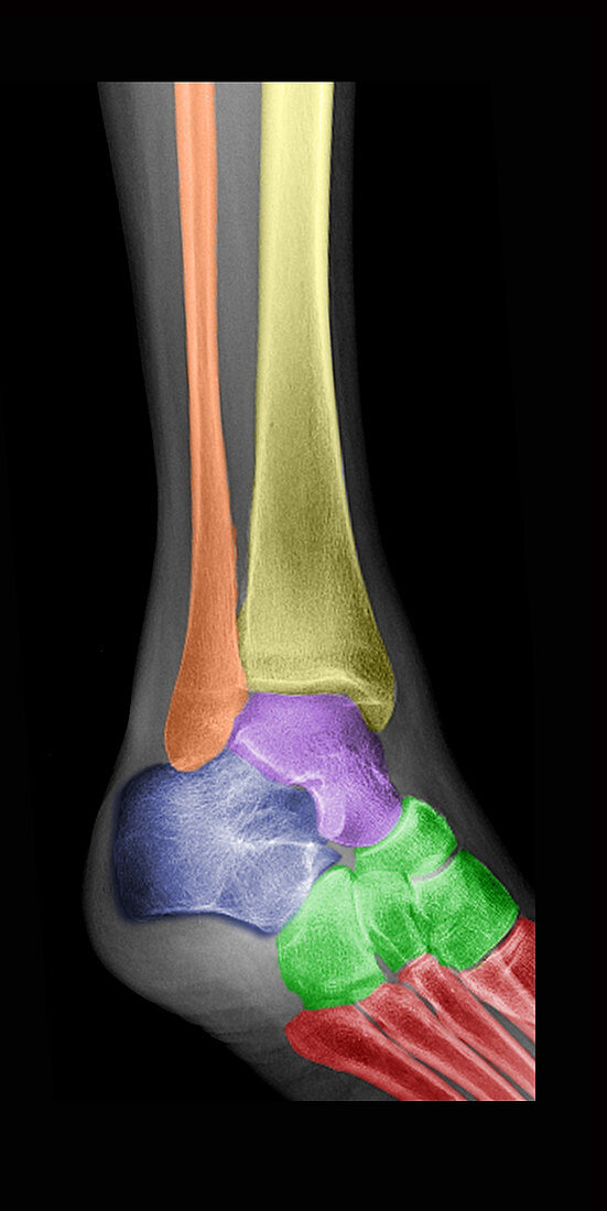 Ankle X-Ray