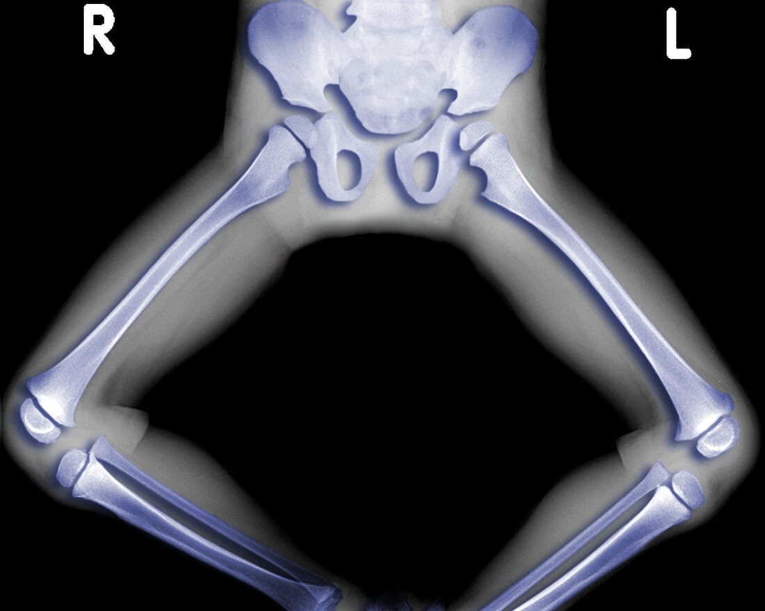 X-Ray of legs in frog position