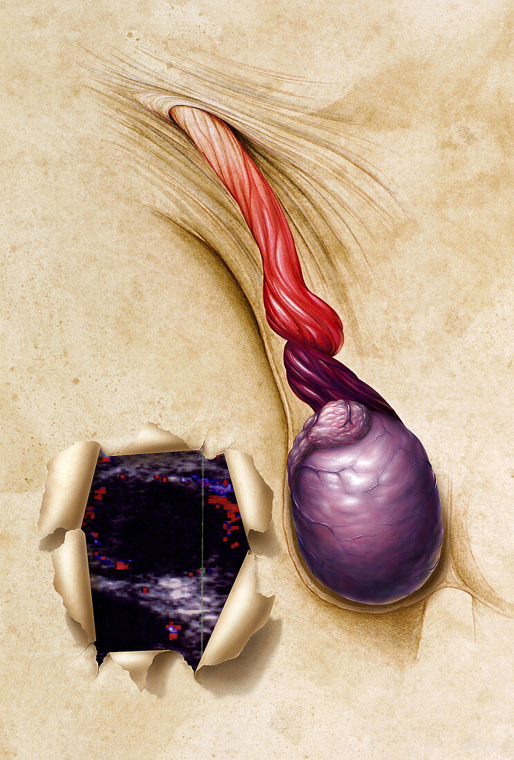 Spermatic Cord twisting