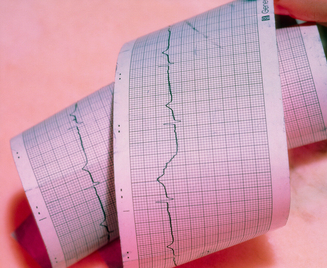 Printed ECG trace of a healthy heartbeat