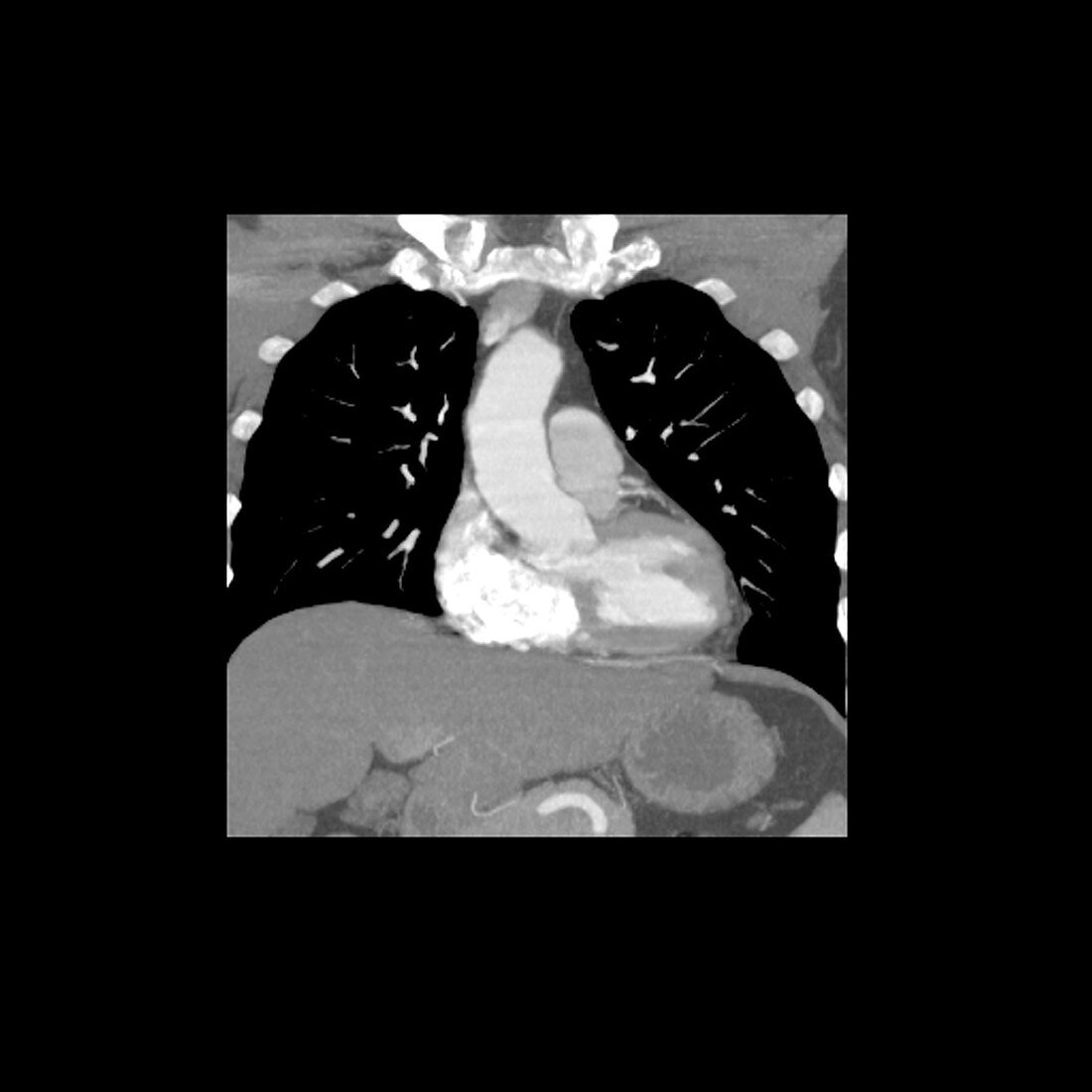 Normal Pulmonary Arteries