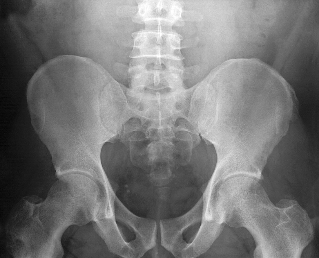 Pelvic X-ray