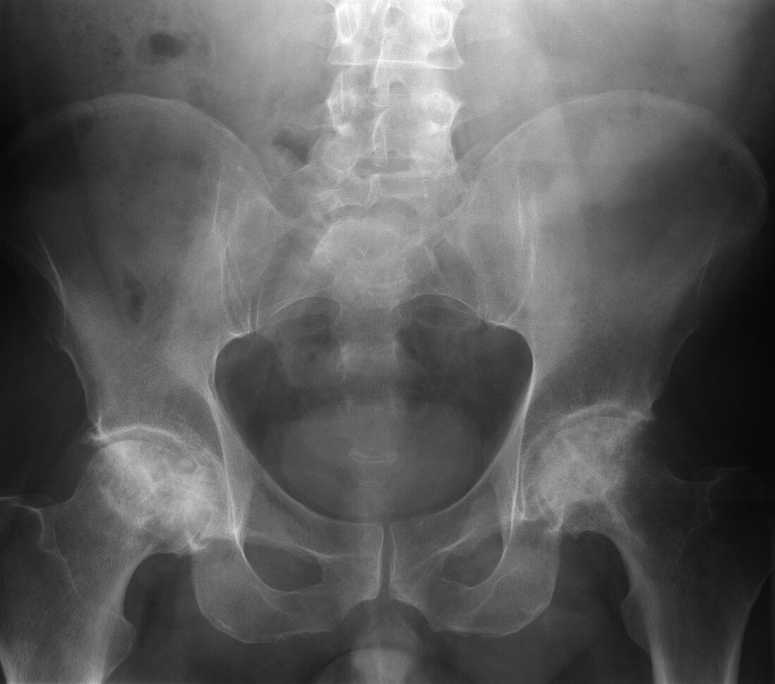X-ray of Compressed Lumbar Spine