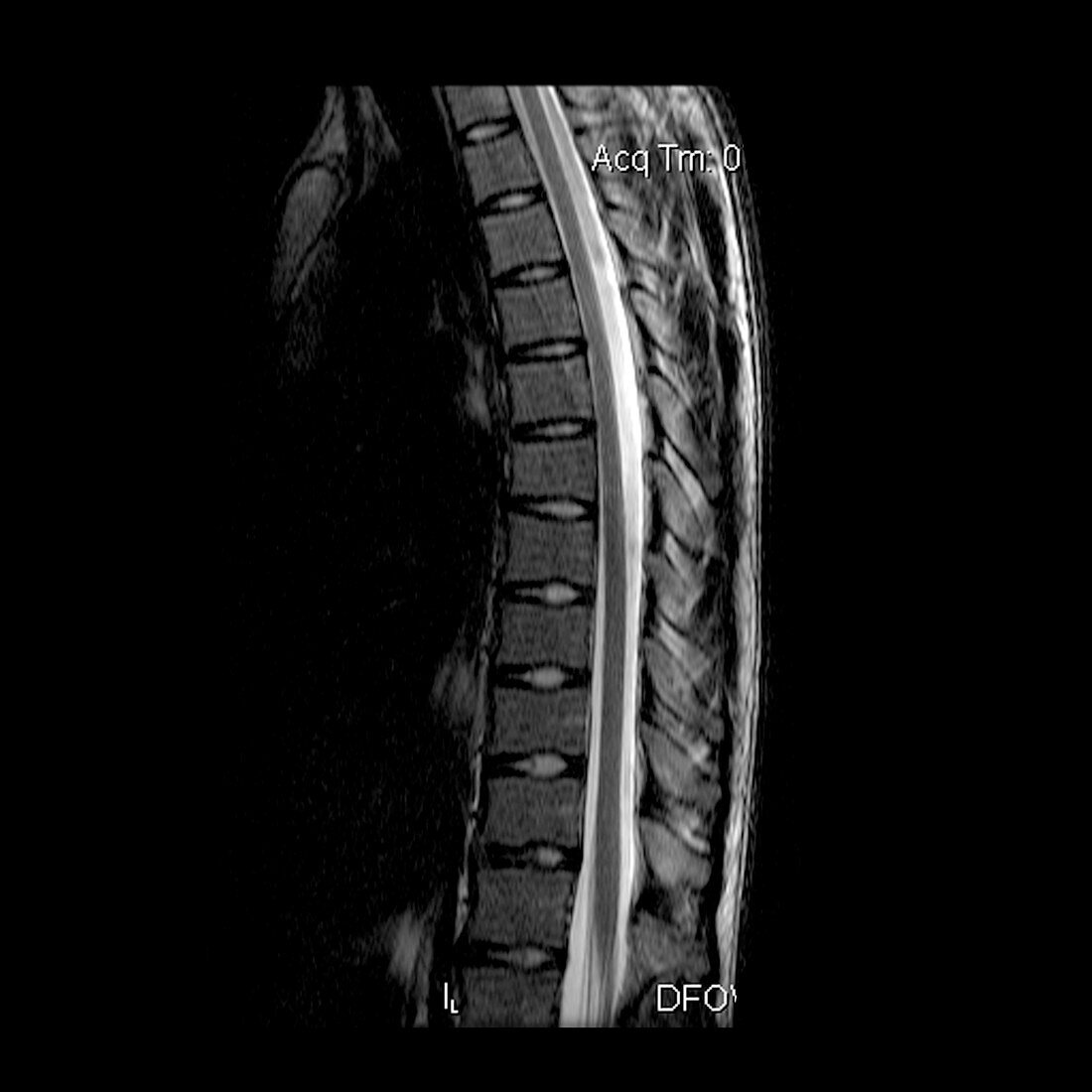 Normal Spine and Spina