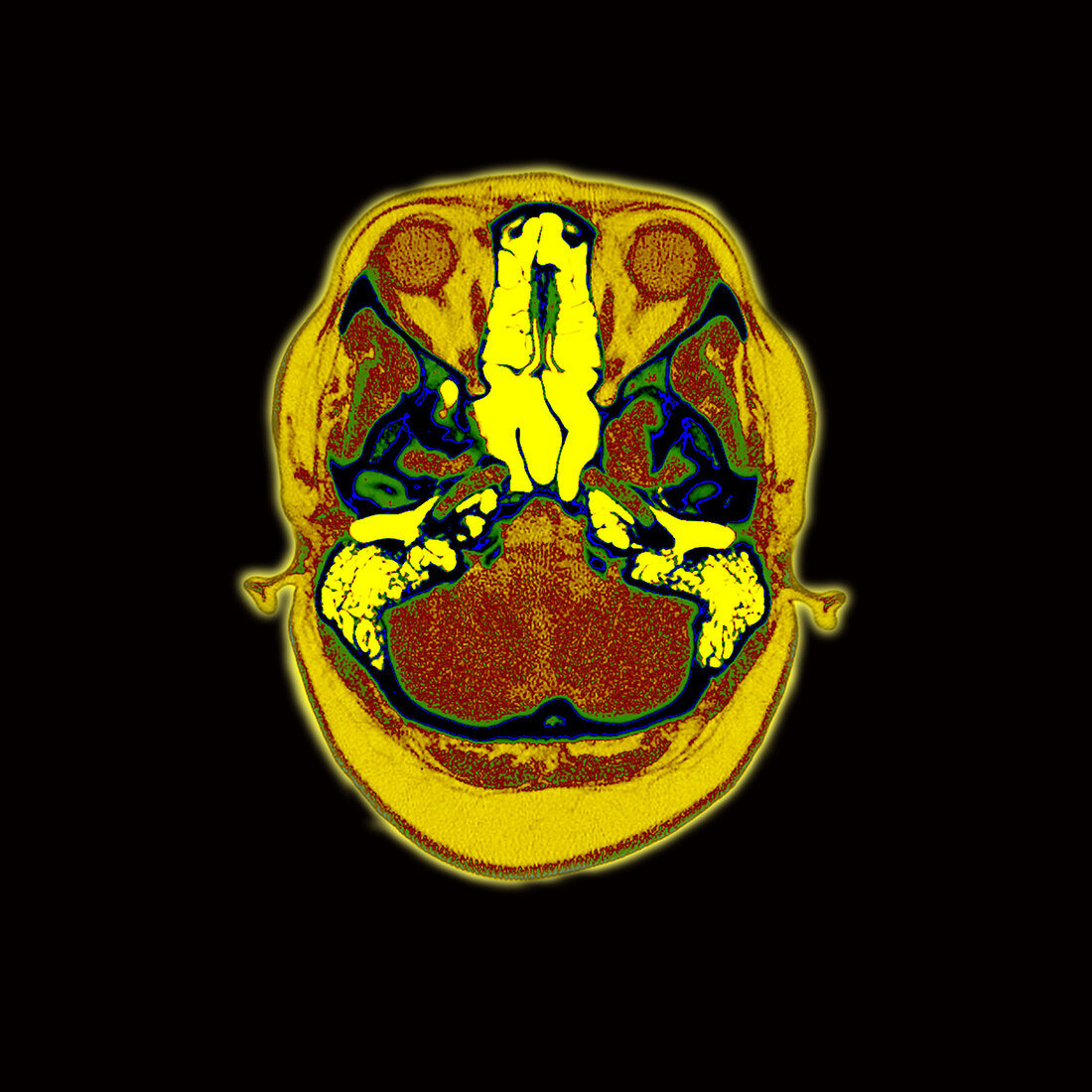 CT Image through Normal Skull Base