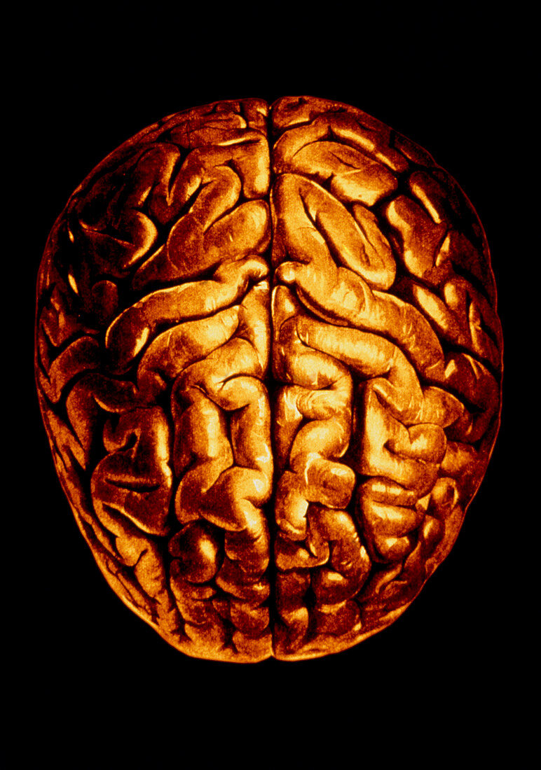 Computer-enhanced image of brain,seen from above