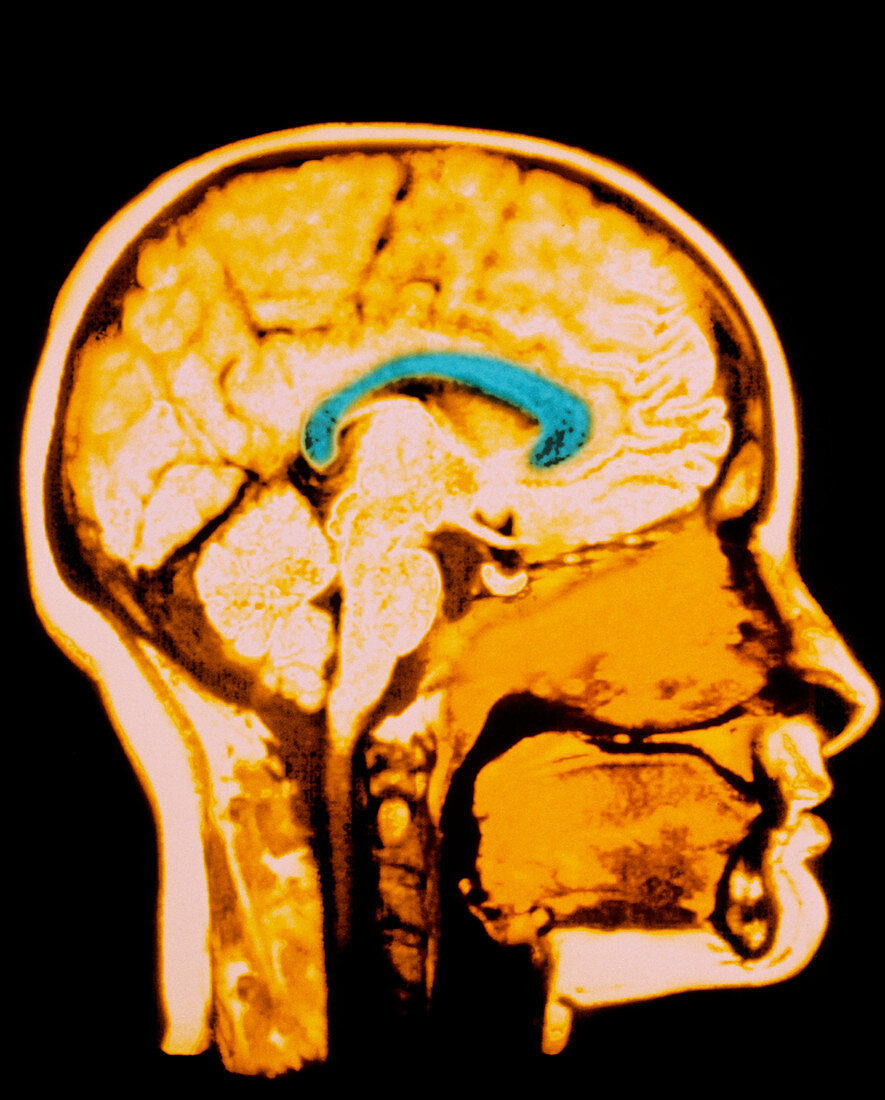 Human head,MRI scan