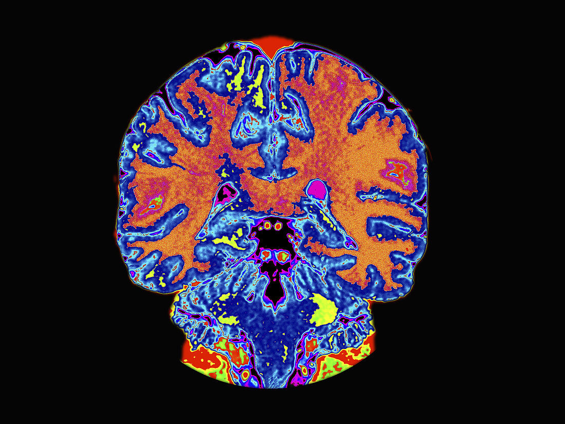 Coronal view MRI of normal brain