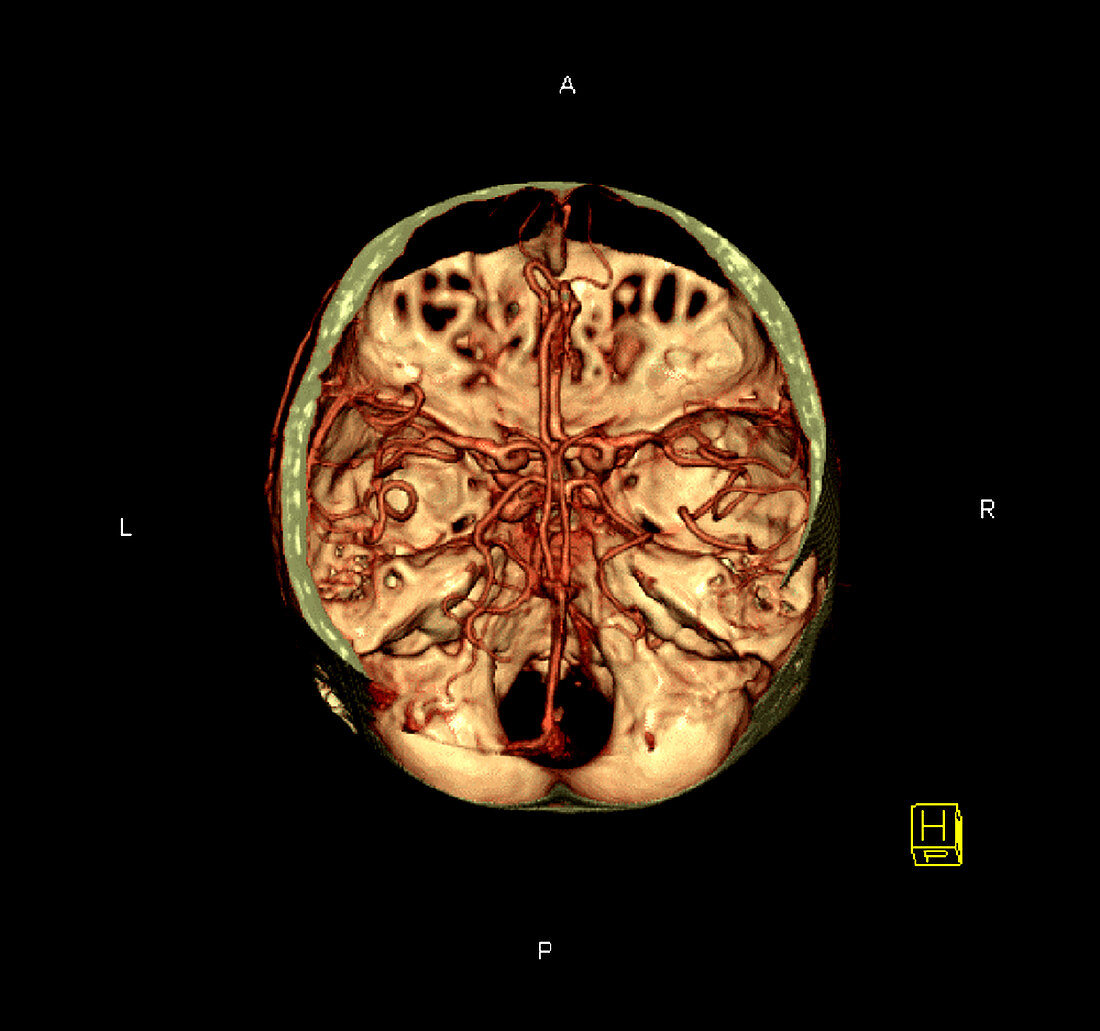 Enhanced 3D CTA of the Brain