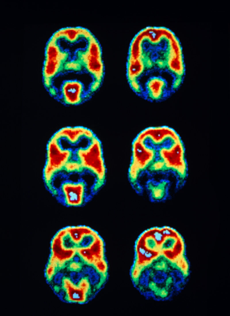 PET scans of the human brain during light stimuli