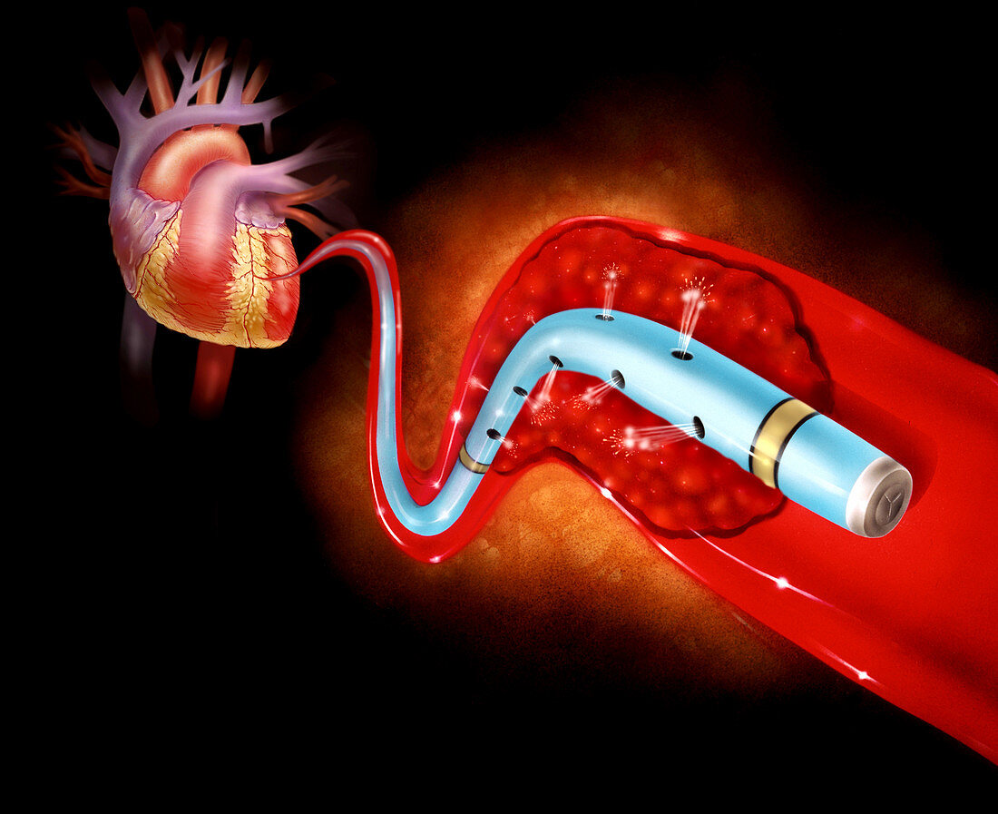Illustration of dissolution of a blood clot