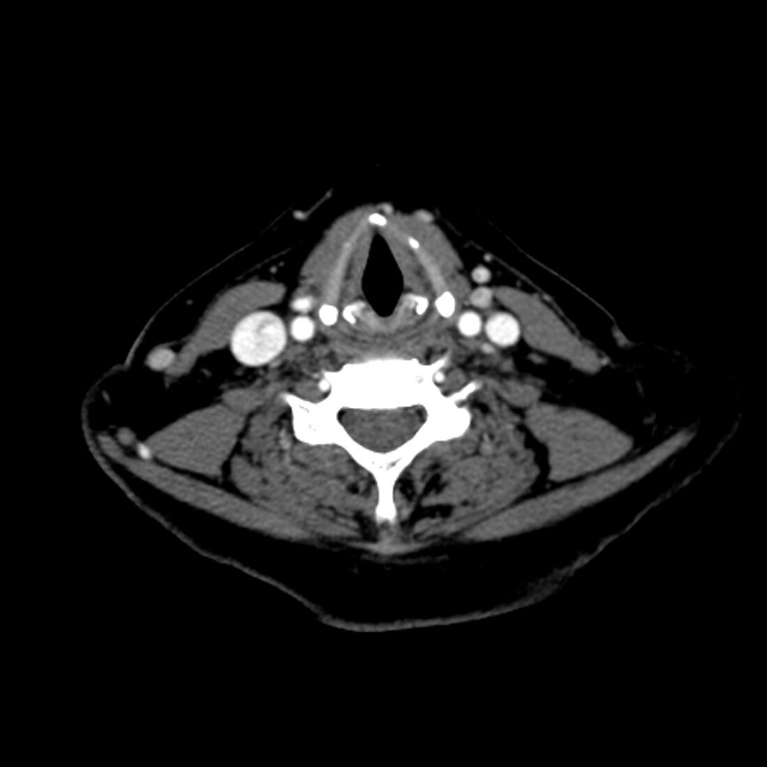 CT of neck showing normal vocal chords