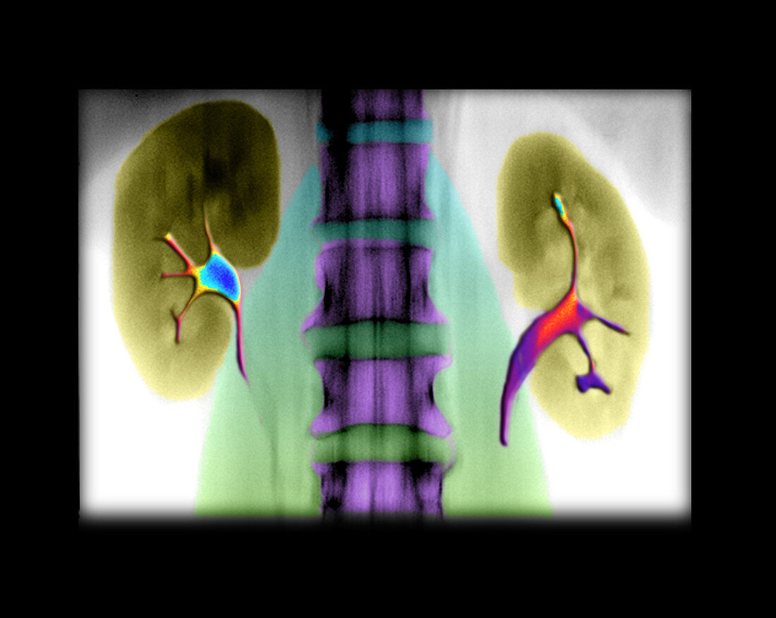 colourized Frontal X-ray from an IVP Version 2