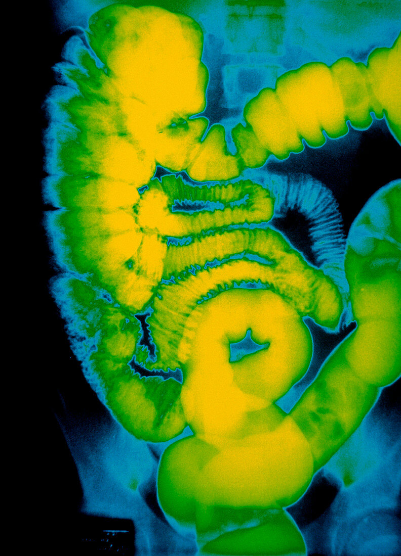 Coloured X-ray of human colon after barium enema