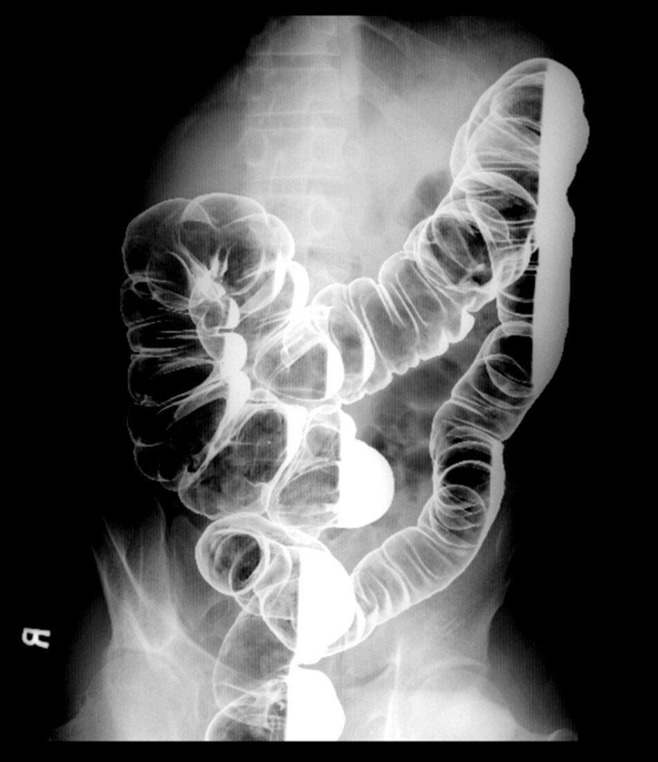 Barium enema x-ray