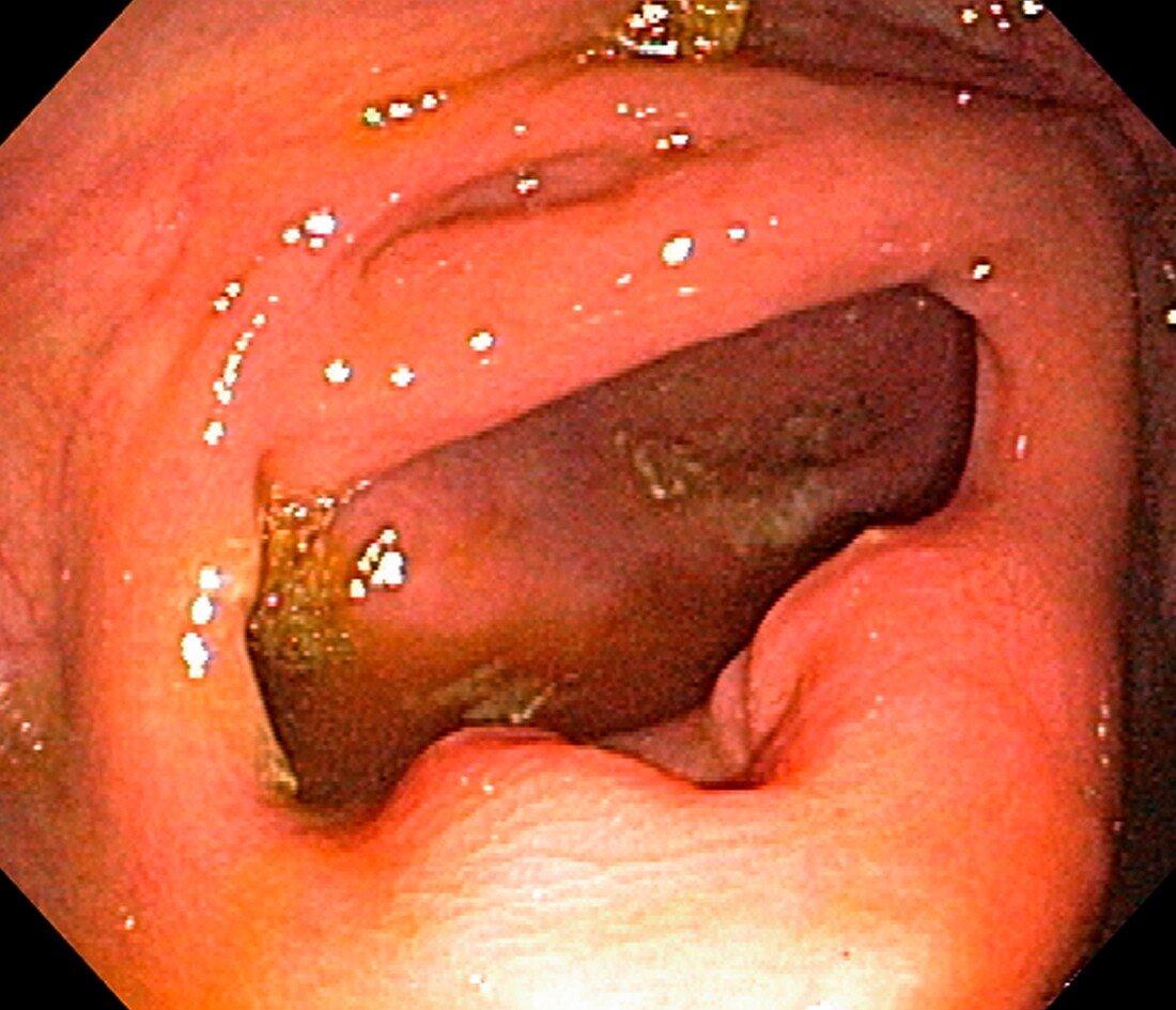 Normal ileo-cecal valve