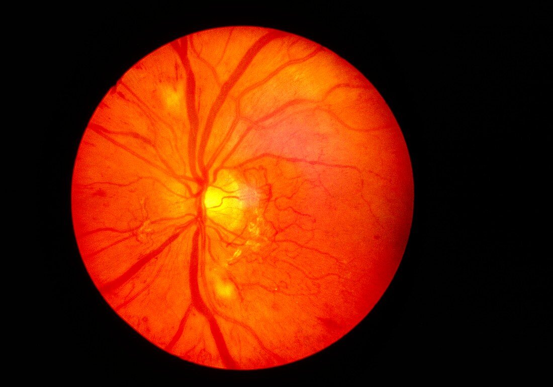 Ophthalmoscope image of a normal,healthy retina