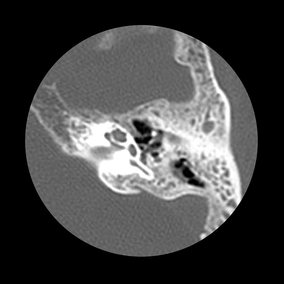 Temporal Bone and Inner Ear Structures