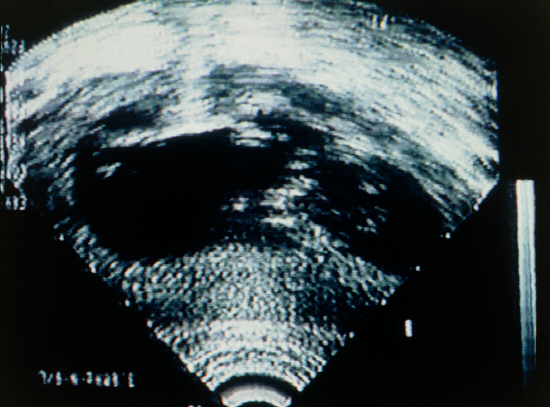Ultrasound scan of abortion in progress