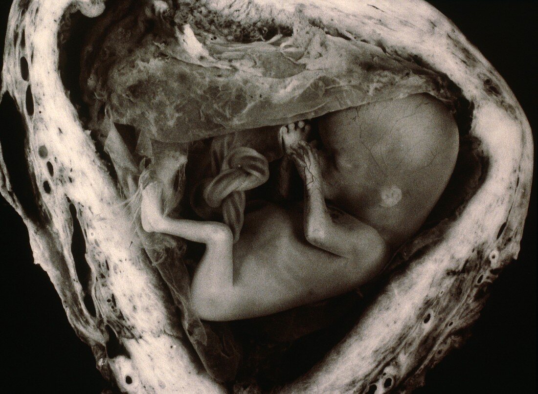 Human foetus at 10 weeks in open uterus