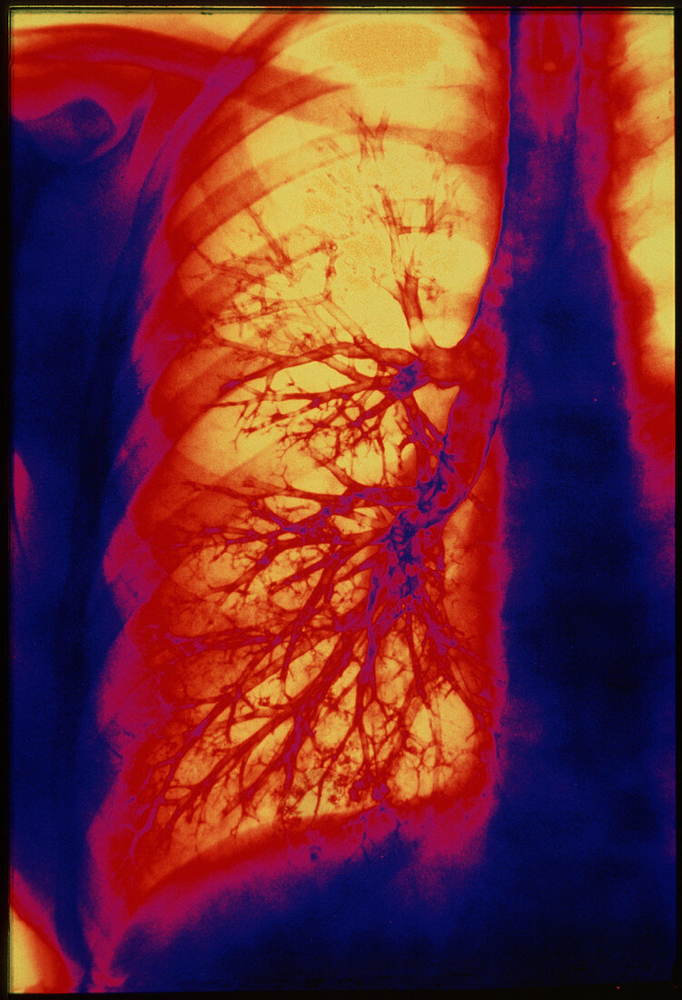 X-ray of lung