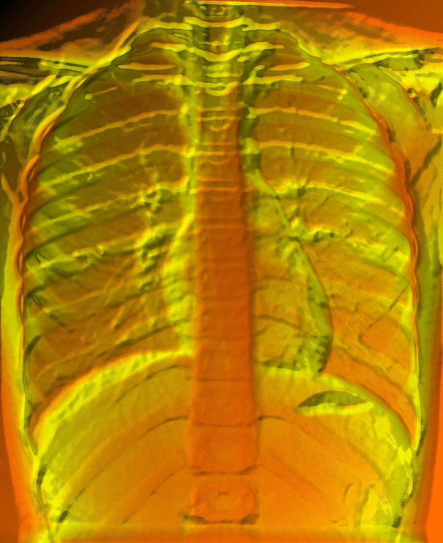 A normal chest X-ray